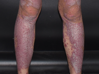 Psoriasis. Source: Image created by the authors; Copyright: Luyuan Wang; URL: https://www.i-jmr.org/2026/1/e86454; License: Creative Commons Attribution (CC-BY).